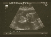 090923_baby2_20_wk_scan_01