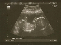 090923_baby2_20_wk_scan_02