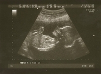 090923_baby2_20_wk_scan_04